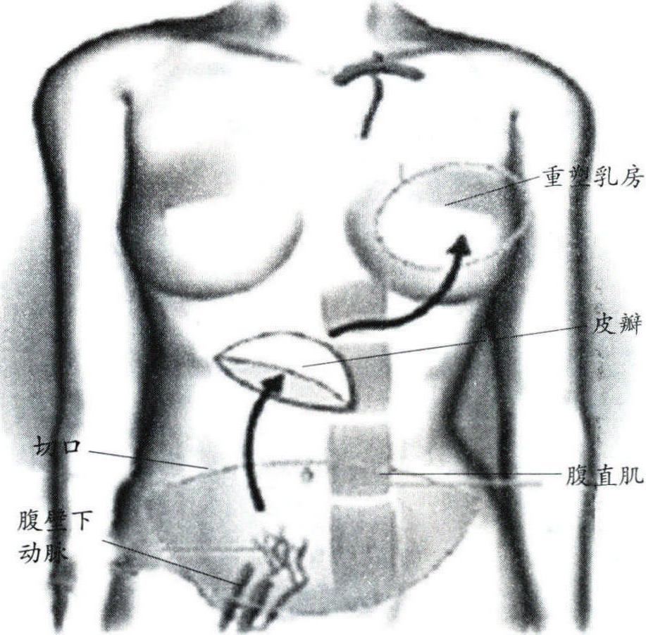 第四節(jié) 橫向腹直肌肌皮瓣乳房再造